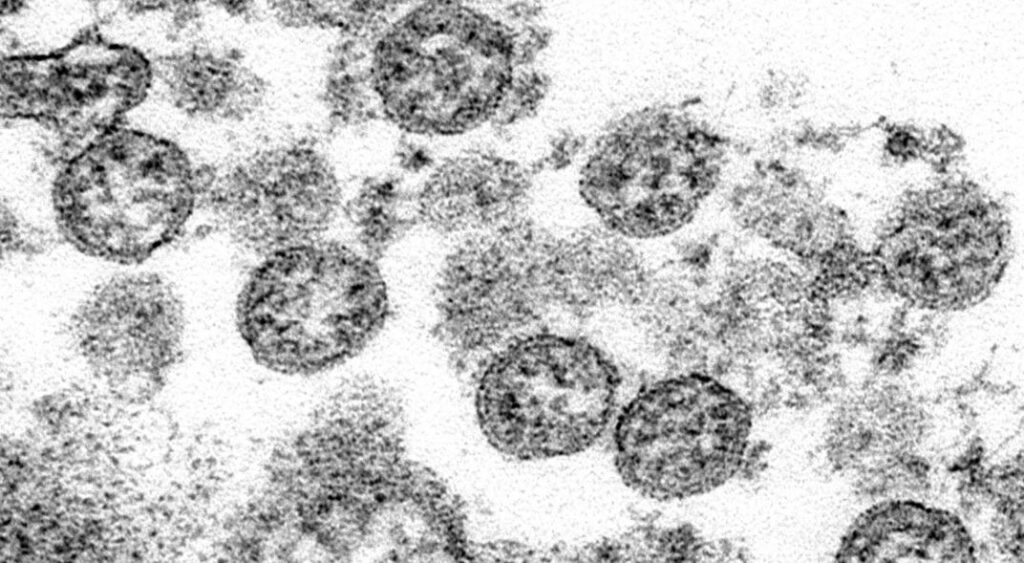 Partículas esféricas de coronavirus vistas a través de un microscopio. AP